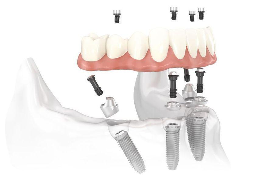 All-on-4 Dental Implants Oklahoma City