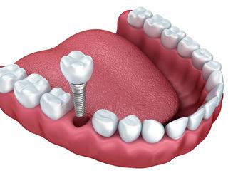 Dental Implants Oklahoma City, OK