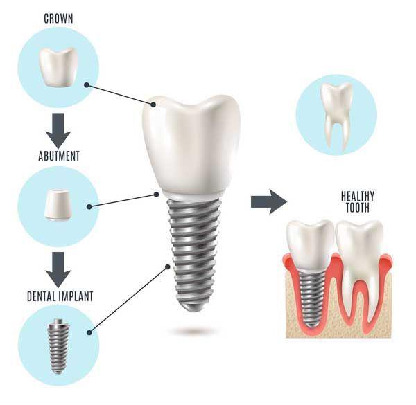 Oklahoma City Dental Implants