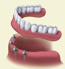 Dentures Oklahoma City OK