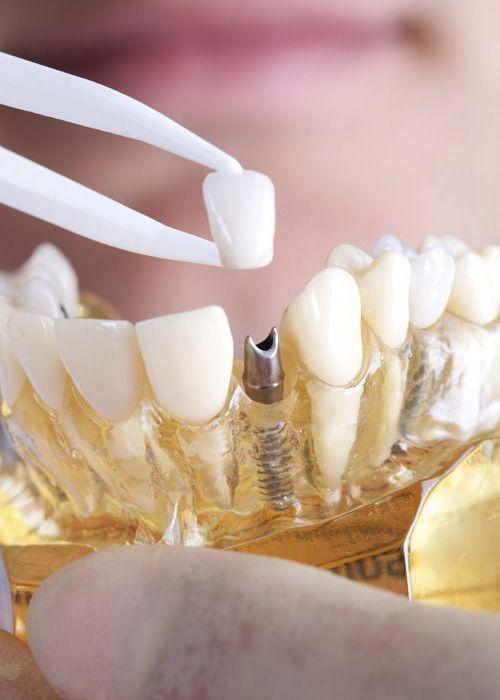 Photo of a dental restoration over a dental implant