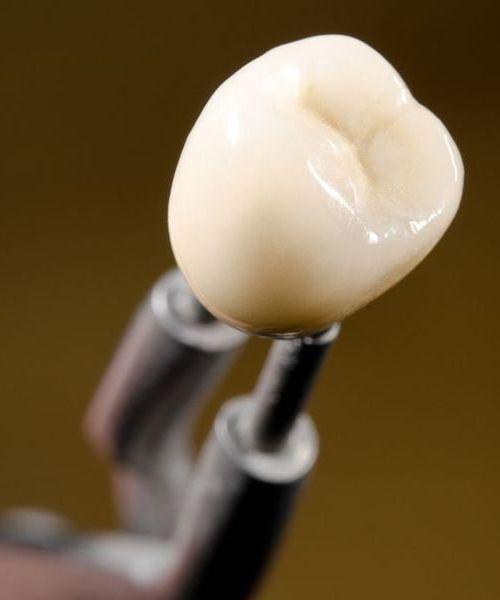 Photo of a dental crown