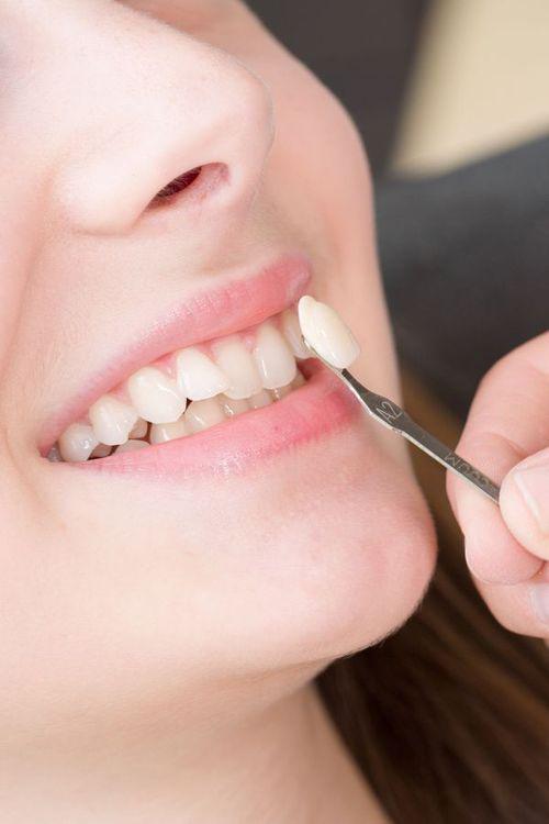 Photo of a veneer held up to a smile