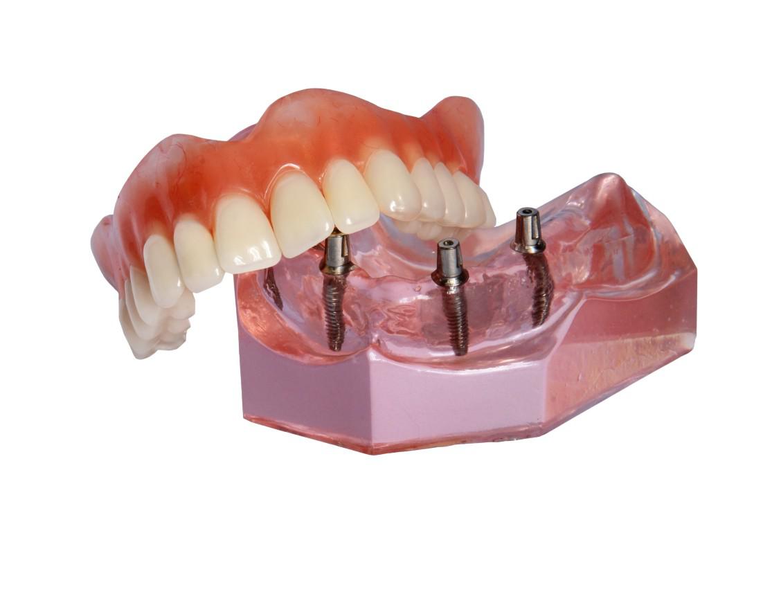 Dental Implants Oklahoma City, OK